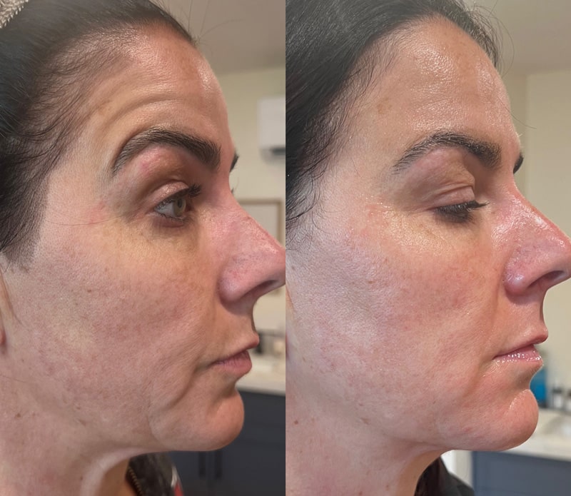 Before and after look at the face of a woman who underwent the CoolJet treatment.