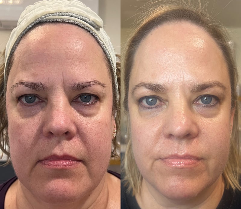 Before and after look at the face of a woman who underwent the CoolJet treatment.