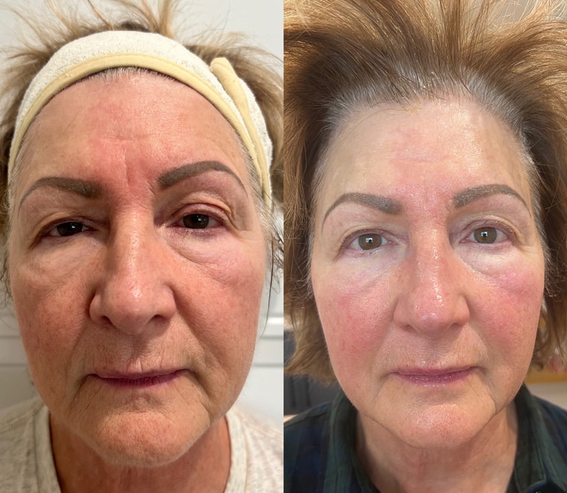 Before and after look at a woman's face who underwent the CoolJet treatment