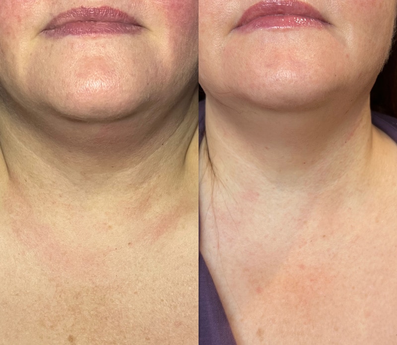 Before and after look at a woman who underwent the CoolJet treatment